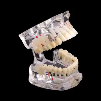 Cesoon Новый Зубной Имплантат Для Лечения заболеваний Зубов Модель M4001 Демонстрация Прозрачной Структуры Высококачественный Материал
